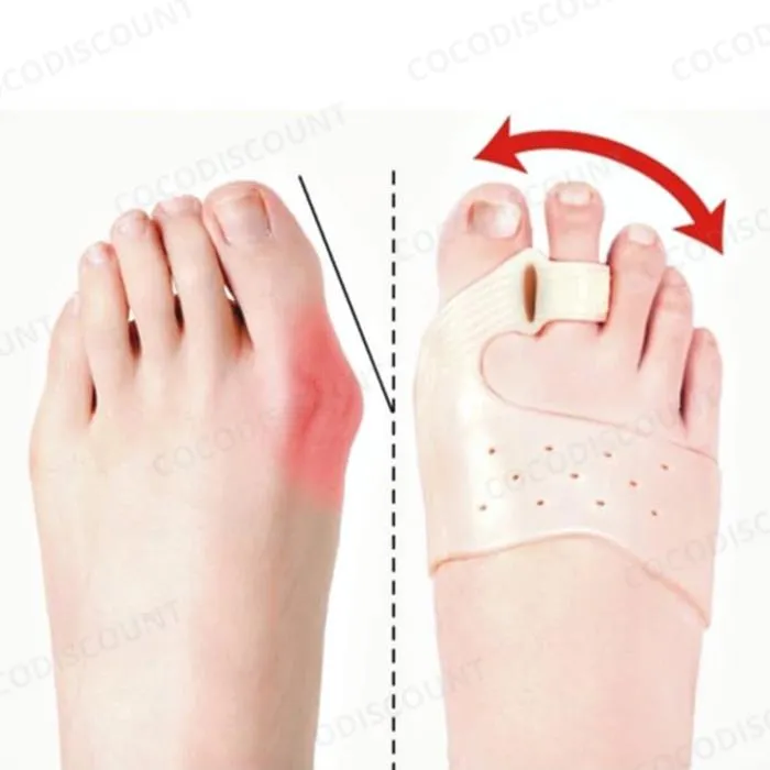 Lot de 2 Séparateurs d’Orteils Hallux Valgus en Gel – Orthèse Correcteur d’Oignon avec Aimants Magnétiques pour Soulager la Douleur du Pied – Image 5